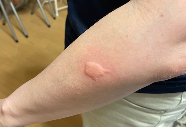 あなたはツタウルシの影響を受けなくなりますか?